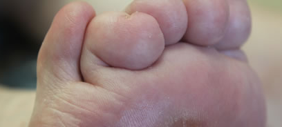 Deformidad congénita dedo pie