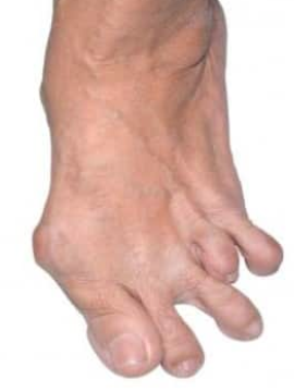 Deformidad dedos pie artritis